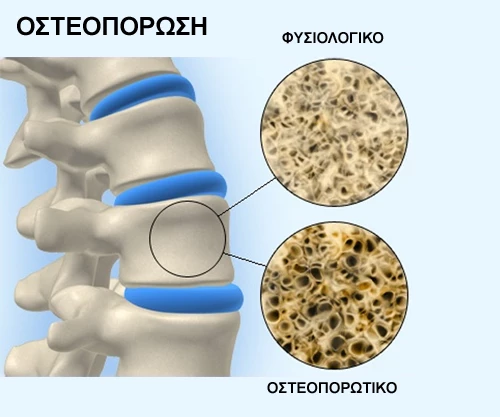 Οστεοπόρωση: Όλη σου τη ζωή την καλλιεργείς σιγά σιγά